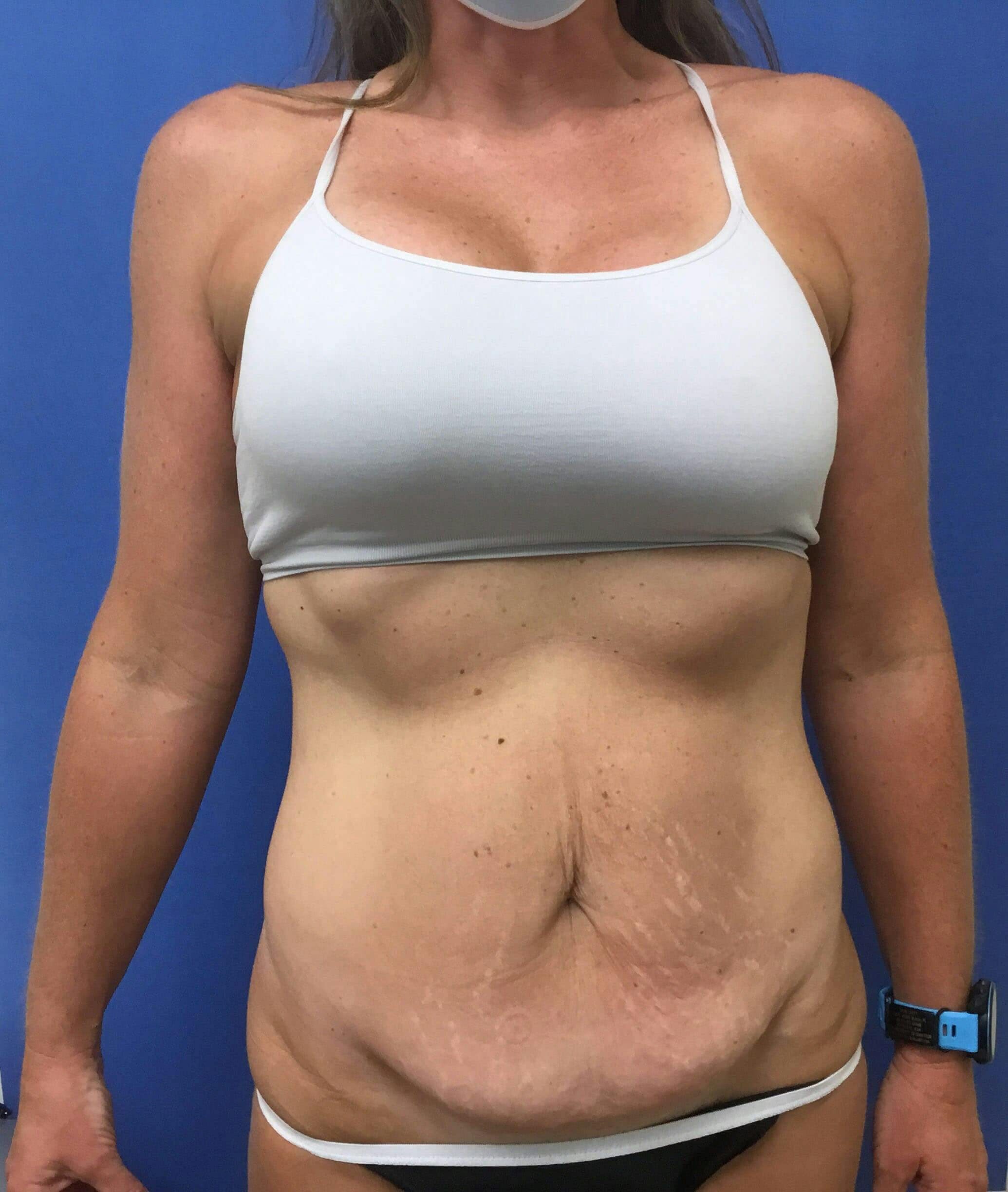 Tummy Tuck Gallery - Patient 89987834 - Image 1