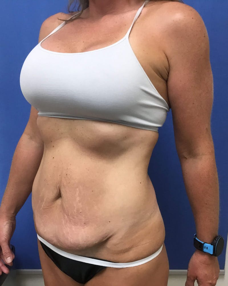 Tummy Tuck Before & After Gallery - Patient 89987834 - Image 3