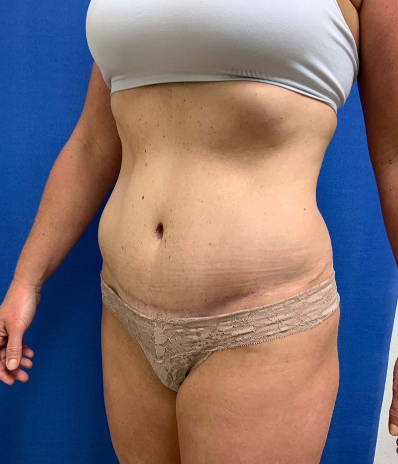 Tummy Tuck Before & After Gallery - Patient 89987834 - Image 4