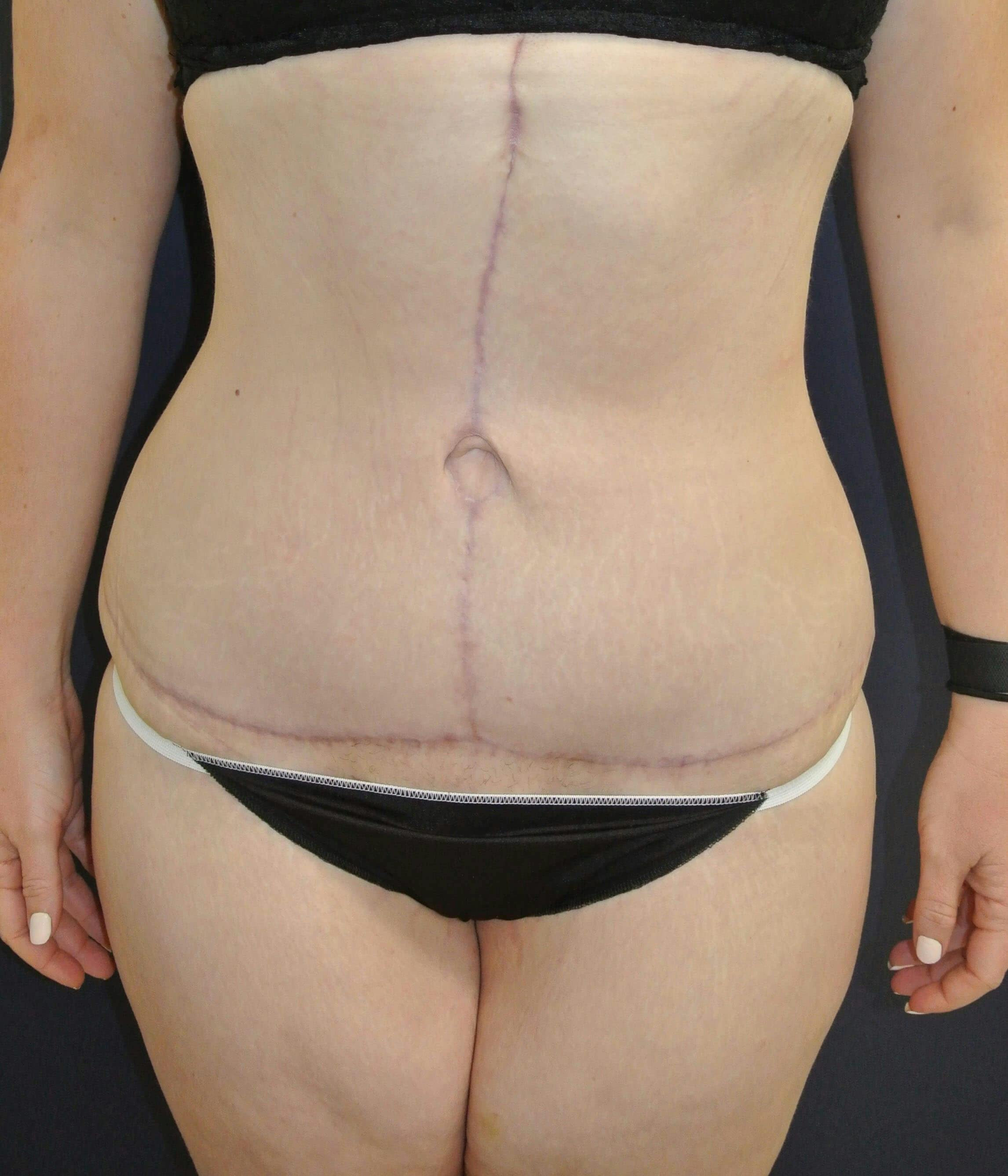 Tummy Tuck Gallery - Patient 89987835 - Image 2
