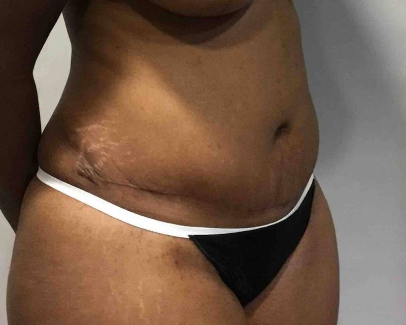 Tummy Tuck Before & After Gallery - Patient 89987841 - Image 6