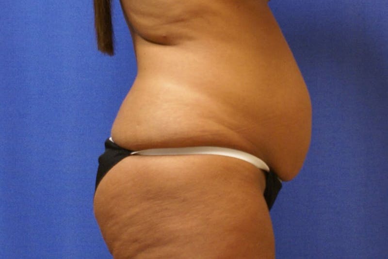 Tummy Tuck Before & After Gallery - Patient 89987848 - Image 1