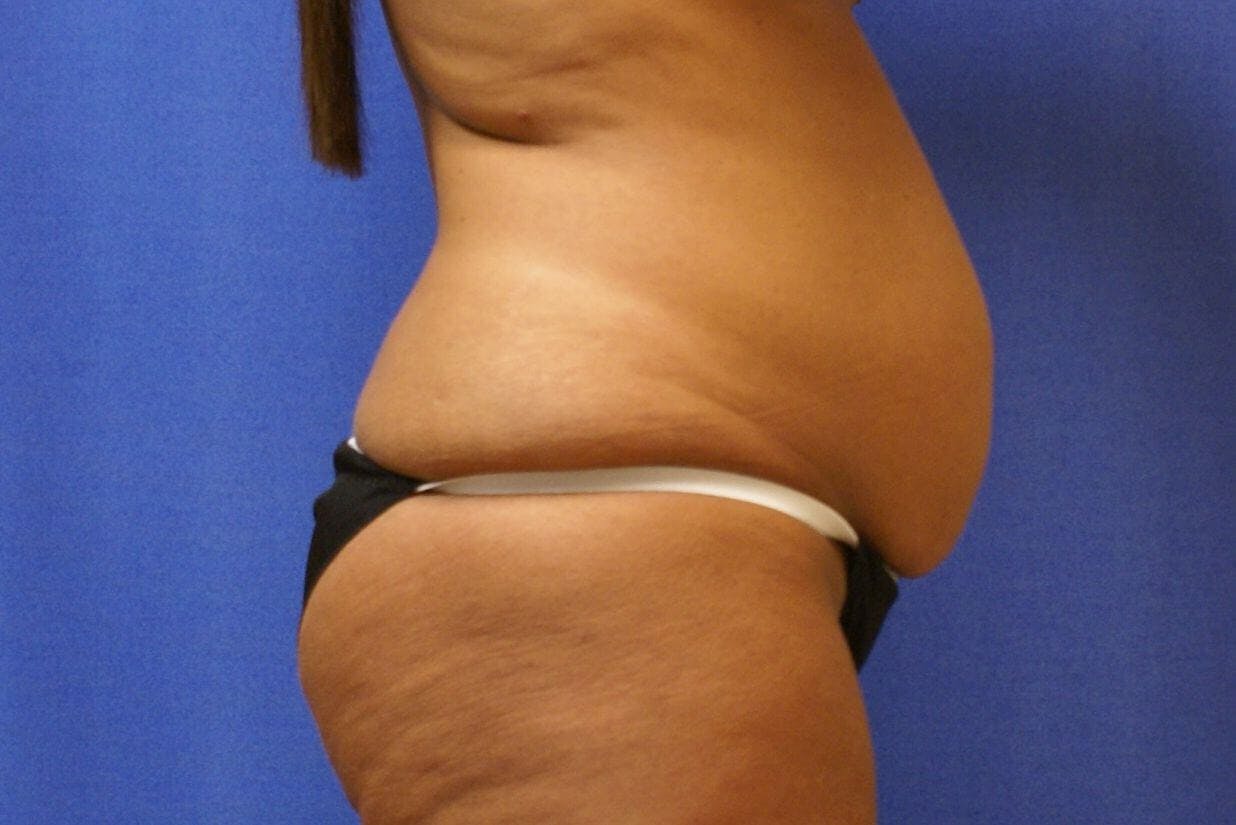 Tummy Tuck Gallery - Patient 89987848 - Image 1