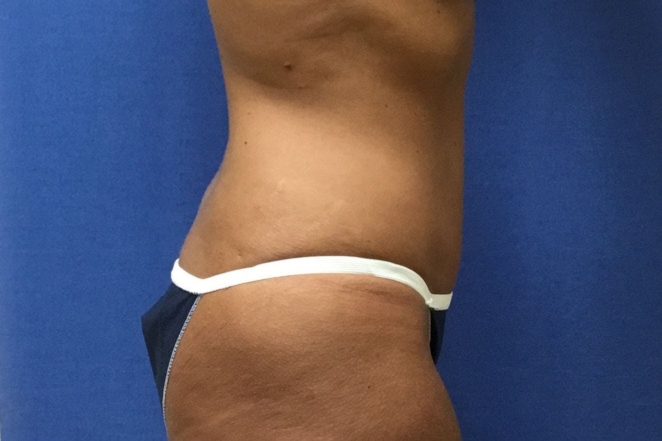 Tummy Tuck Gallery - Patient 89987848 - Image 2