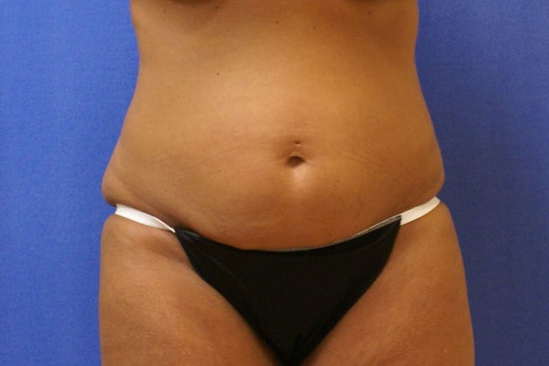 Tummy Tuck Before & After Gallery - Patient 89987848 - Image 3