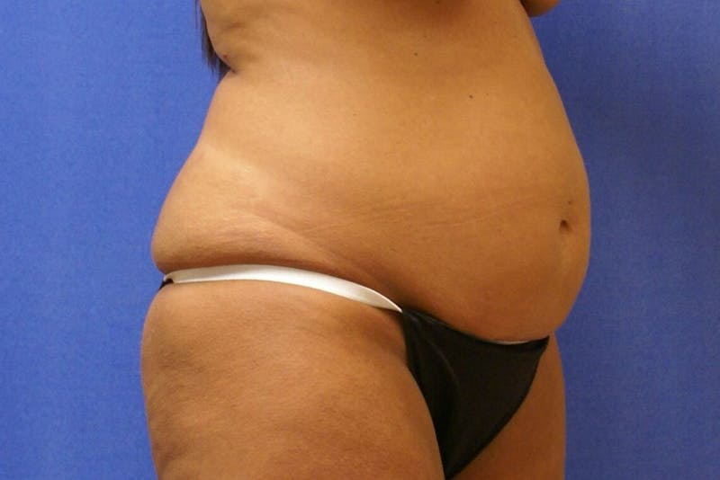 Tummy Tuck Before & After Gallery - Patient 89987848 - Image 5
