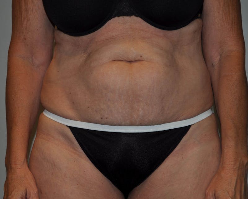 Tummy Tuck Before & After Gallery - Patient 89987849 - Image 1