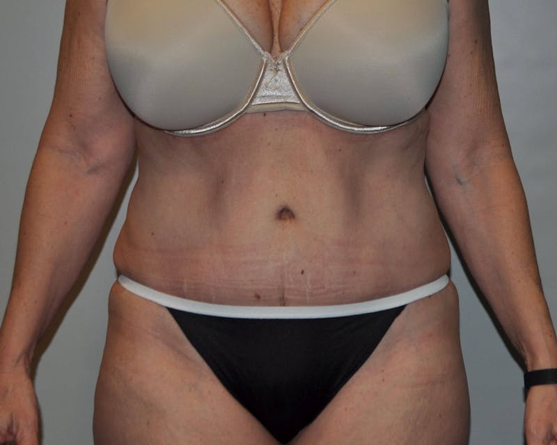 Tummy Tuck Before & After Gallery - Patient 89987849 - Image 2