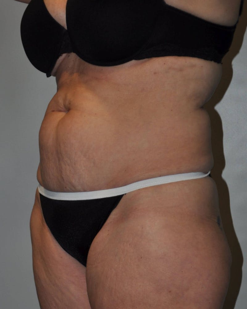 Tummy Tuck Before & After Gallery - Patient 89987849 - Image 3