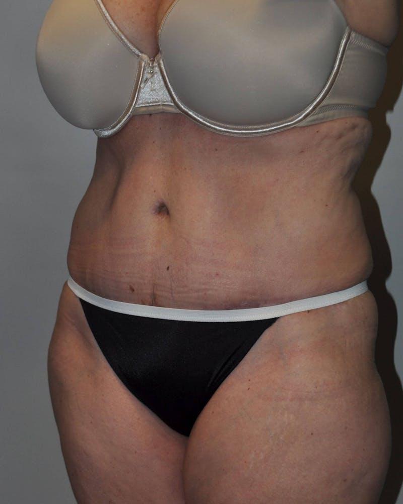 Tummy Tuck Before & After Gallery - Patient 89987849 - Image 4