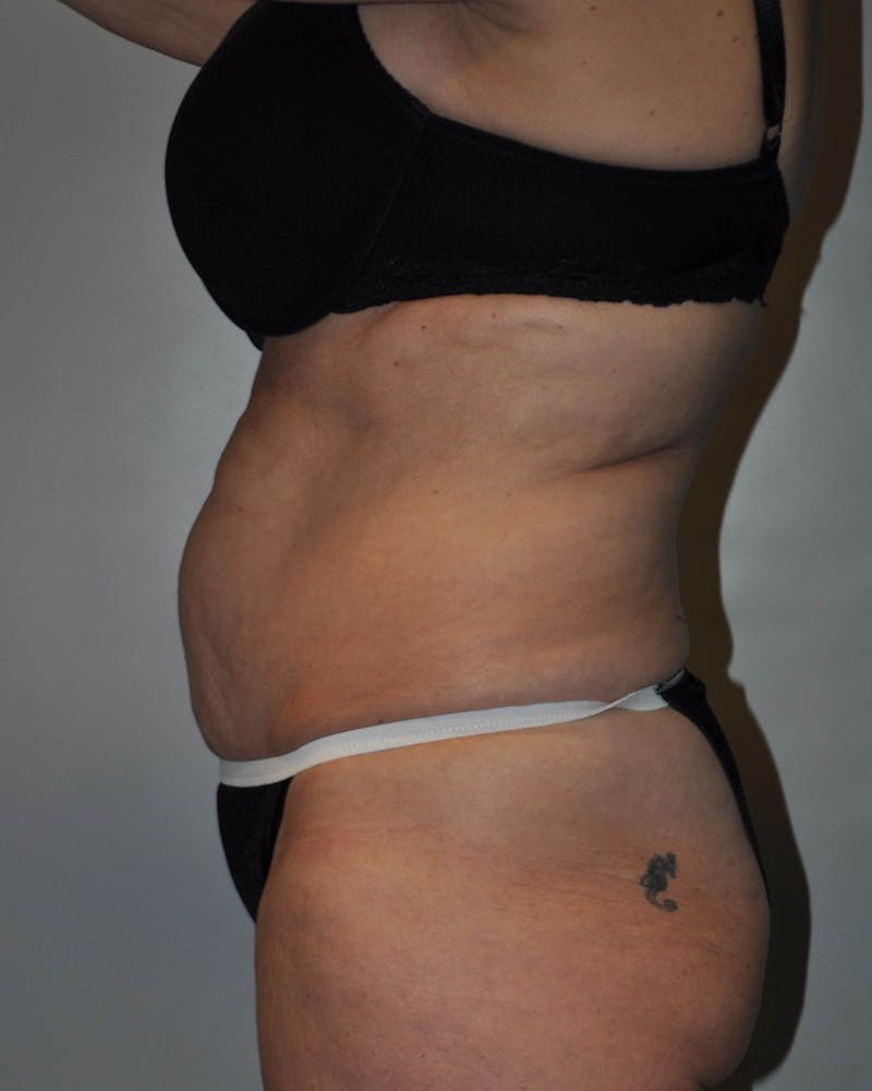 Tummy Tuck Before & After Gallery - Patient 89987849 - Image 5