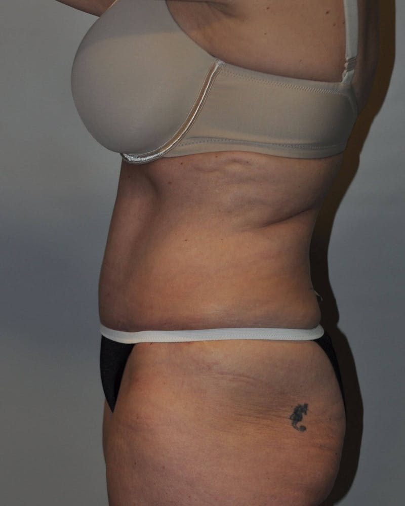 Tummy Tuck Before & After Gallery - Patient 89987849 - Image 6