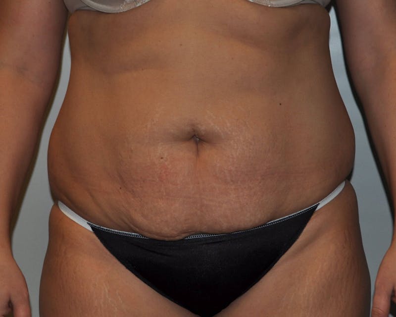 Tummy Tuck Before & After Gallery - Patient 89987851 - Image 1