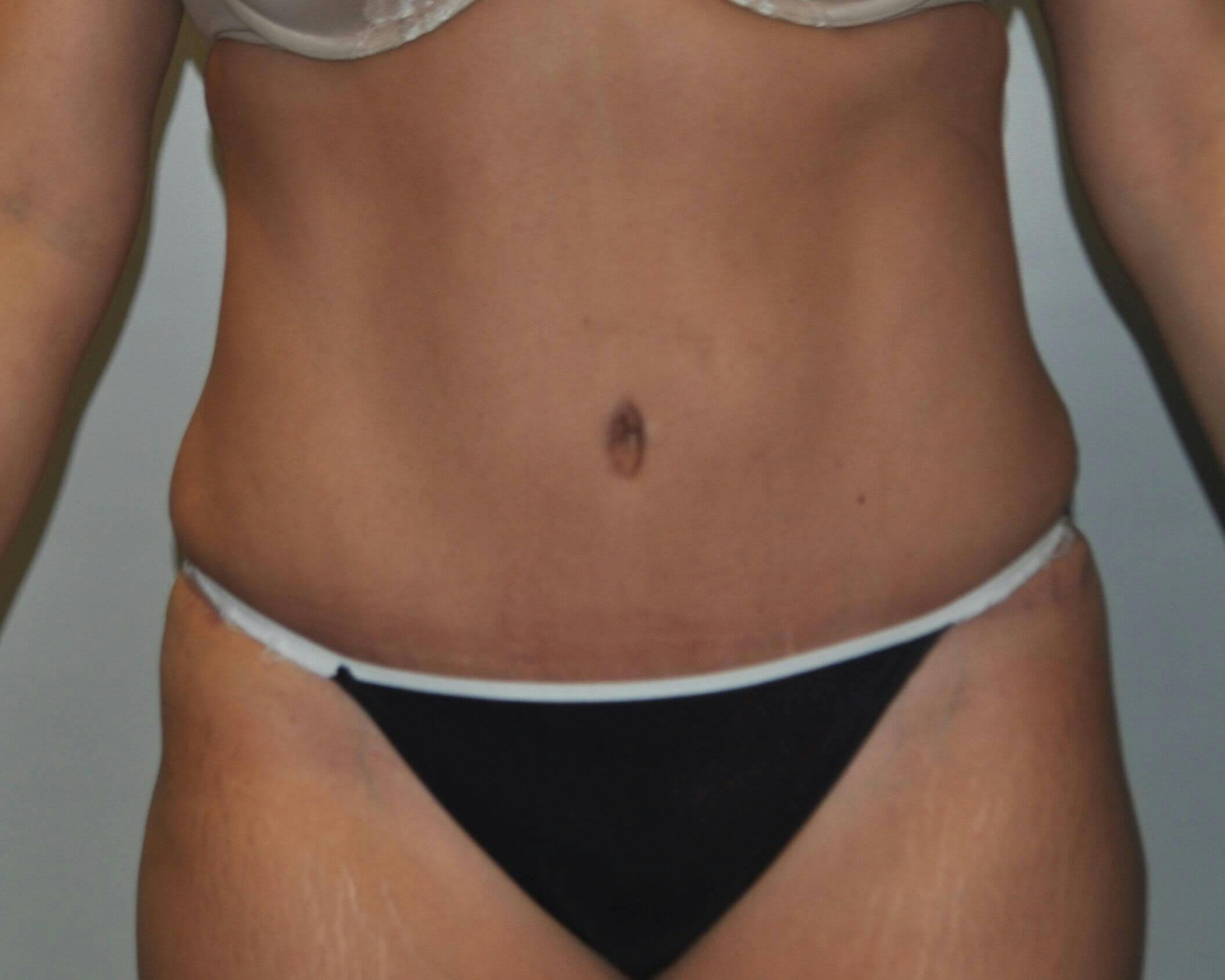 Tummy Tuck Gallery - Patient 89987851 - Image 2