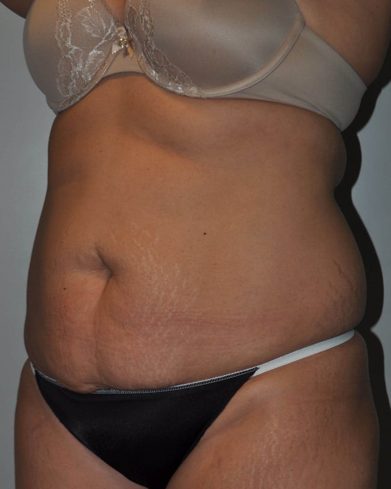 Tummy Tuck Before & After Gallery - Patient 89987851 - Image 3