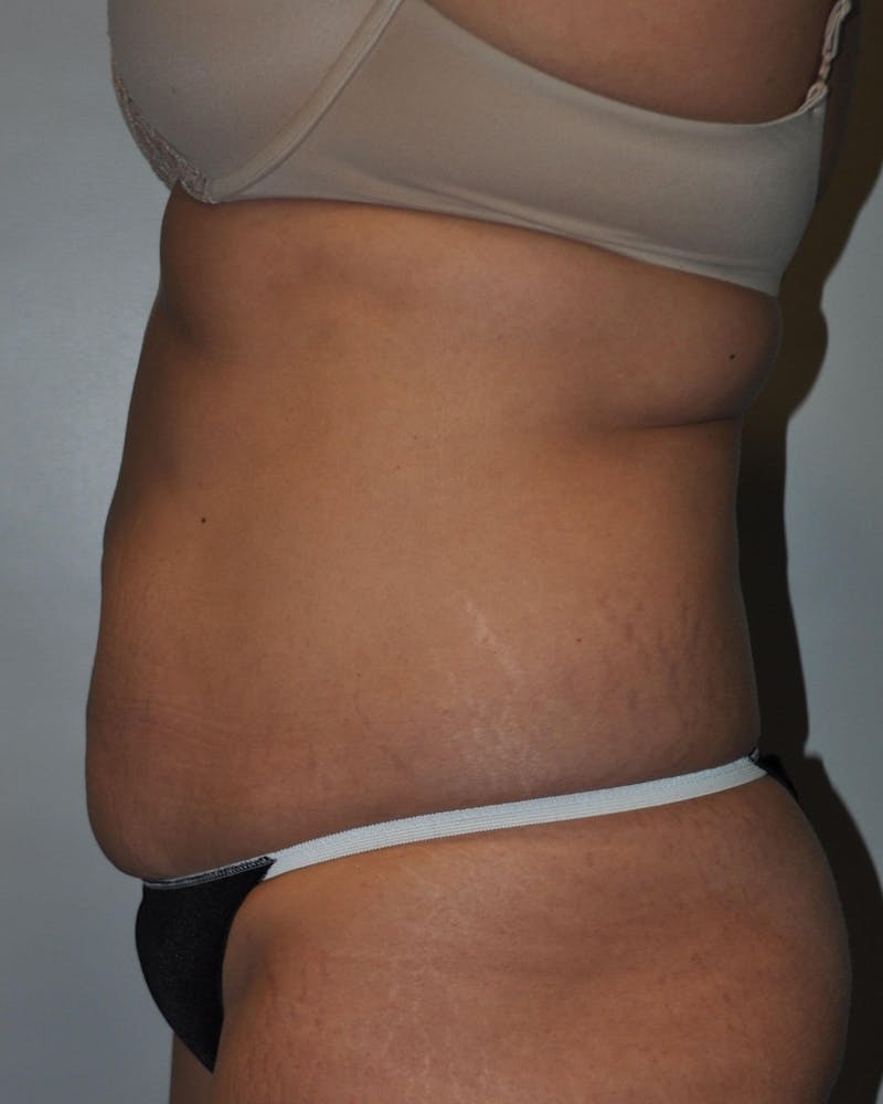 Tummy Tuck Before & After Gallery - Patient 89987851 - Image 5