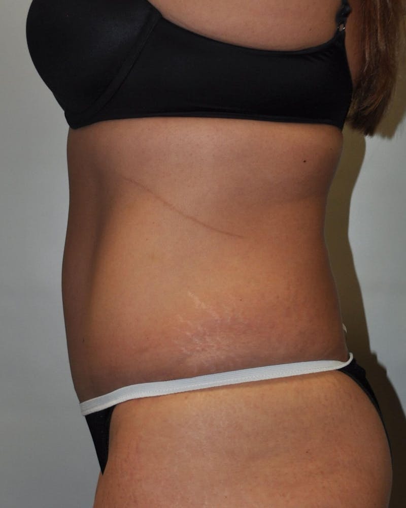 Tummy Tuck Before & After Gallery - Patient 89987851 - Image 6