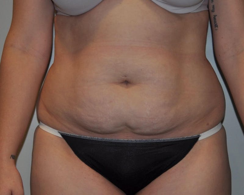 Tummy Tuck Before & After Gallery - Patient 89987852 - Image 1