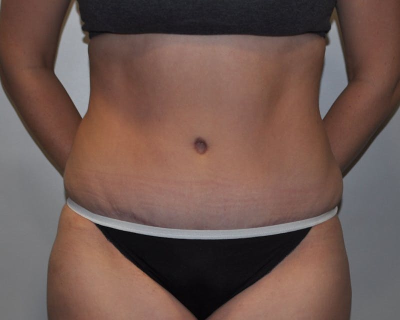 Tummy Tuck Before & After Gallery - Patient 89987852 - Image 2