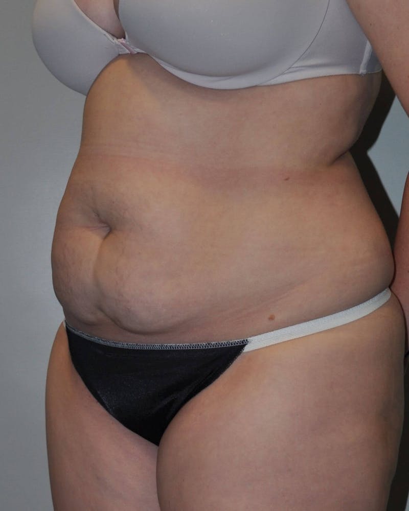 Tummy Tuck Before & After Gallery - Patient 89987852 - Image 3