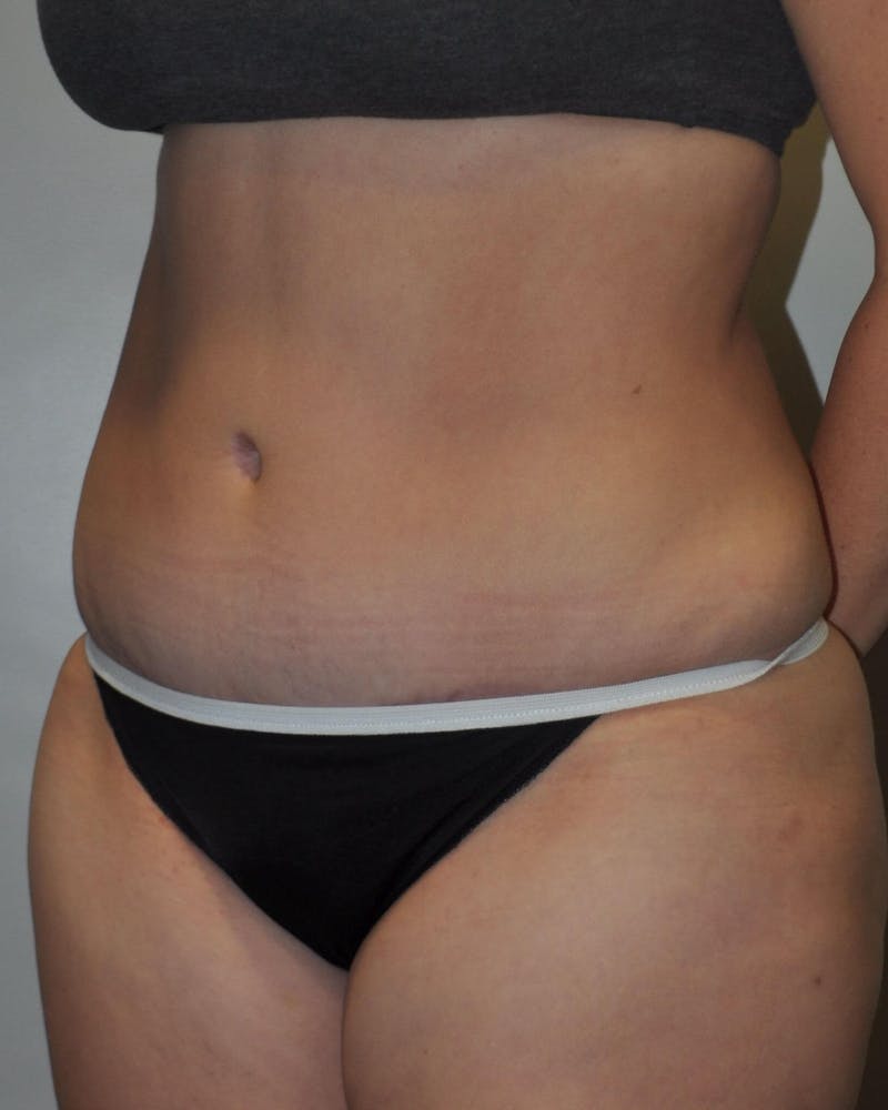 Tummy Tuck Before & After Gallery - Patient 89987852 - Image 4