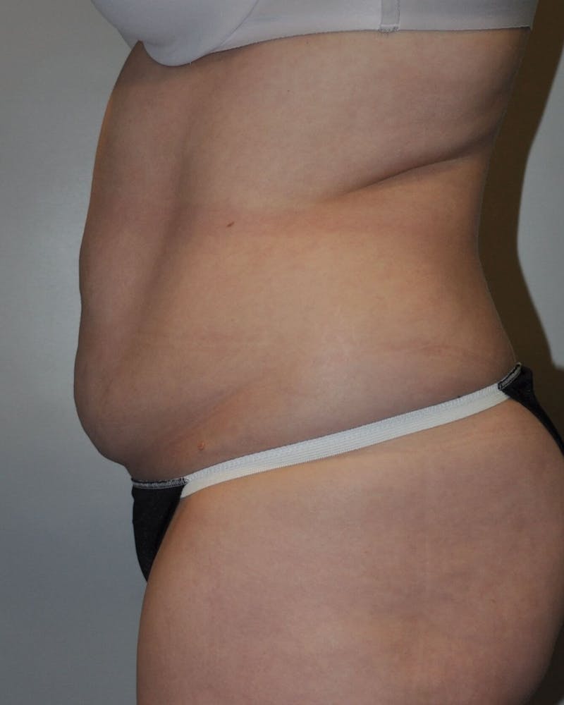 Tummy Tuck Before & After Gallery - Patient 89987852 - Image 5