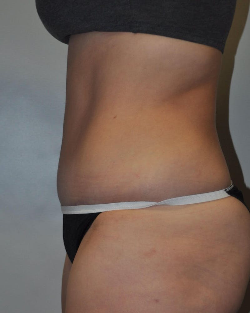 Tummy Tuck Before & After Gallery - Patient 89987852 - Image 6