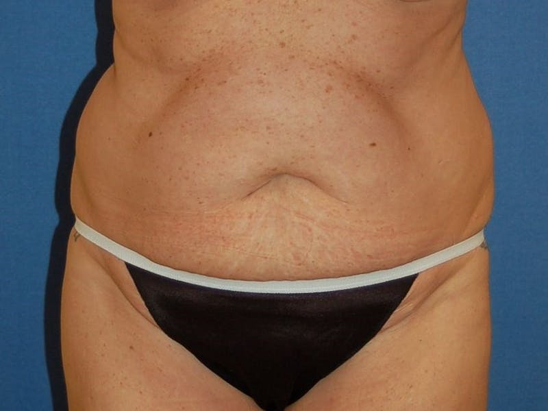 Tummy Tuck Before & After Gallery - Patient 89987853 - Image 1