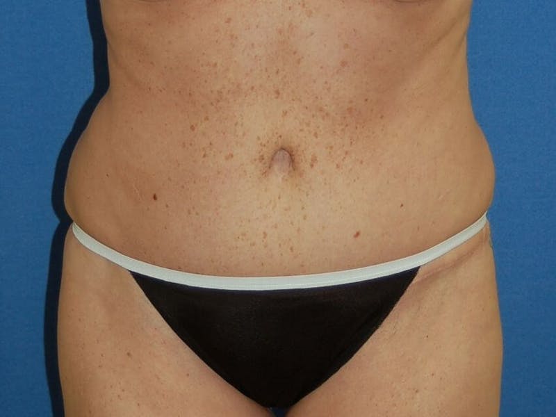 Tummy Tuck Before & After Gallery - Patient 89987853 - Image 2