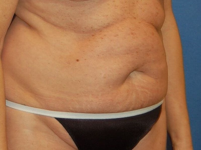 Tummy Tuck Before & After Gallery - Patient 89987853 - Image 3