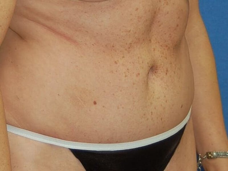 Tummy Tuck Before & After Gallery - Patient 89987853 - Image 4