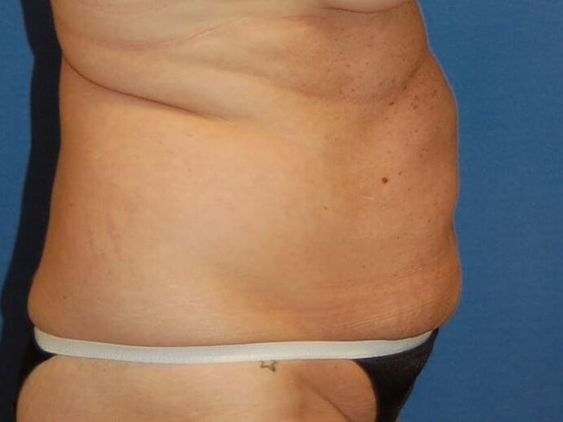 Tummy Tuck Before & After Gallery - Patient 89987853 - Image 5