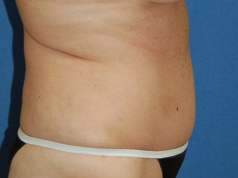 Tummy Tuck Before & After Gallery - Patient 89987853 - Image 6