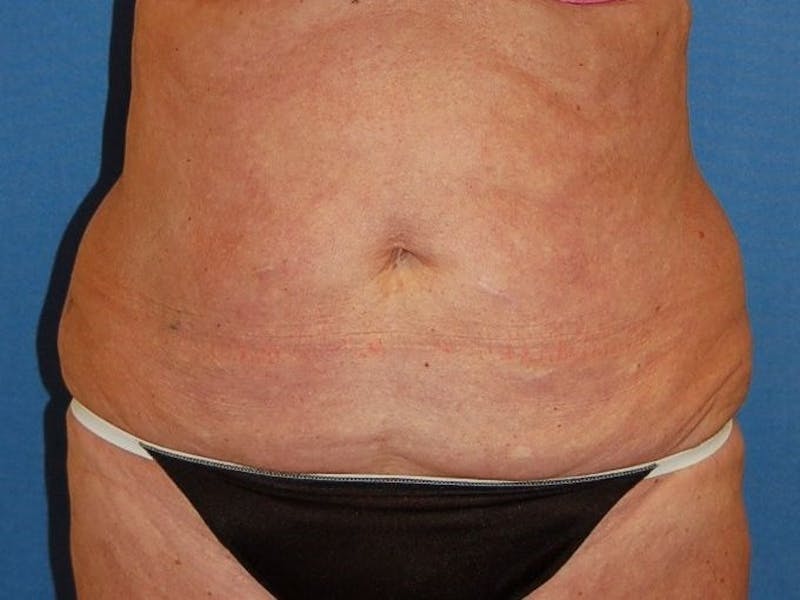 Tummy Tuck Before & After Gallery - Patient 89987854 - Image 1
