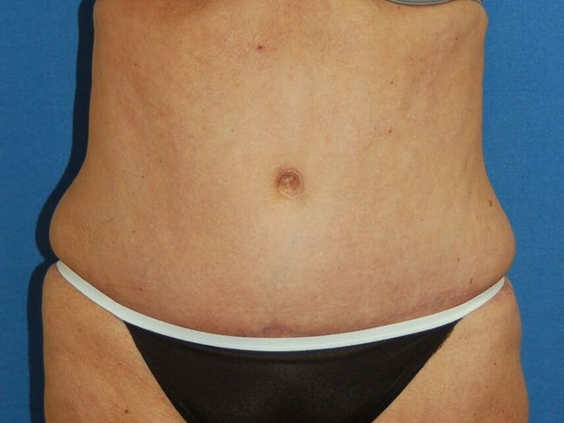 Tummy Tuck Before & After Gallery - Patient 89987854 - Image 2