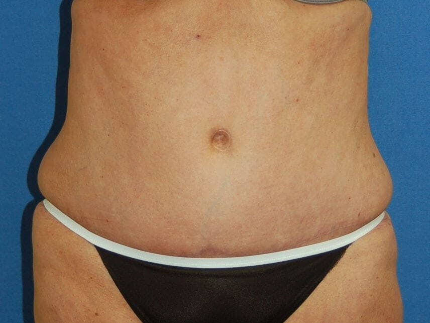 Tummy Tuck Gallery - Patient 89987854 - Image 2