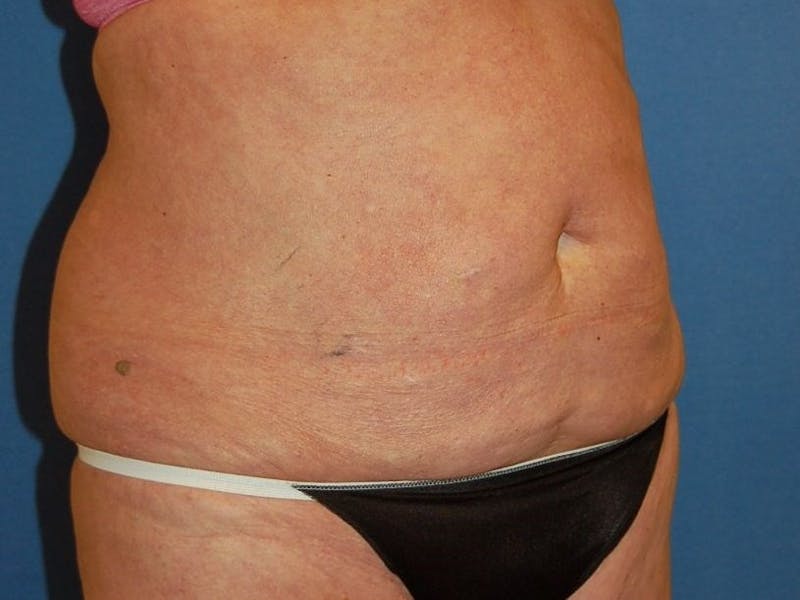 Tummy Tuck Before & After Gallery - Patient 89987854 - Image 3