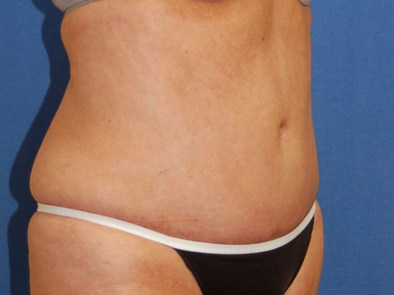 Tummy Tuck Before & After Gallery - Patient 89987854 - Image 4