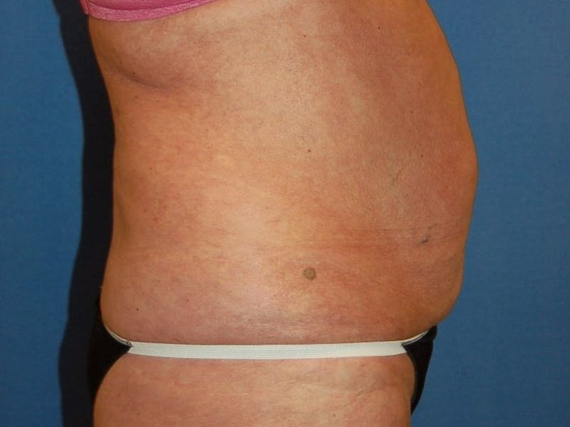 Tummy Tuck Before & After Gallery - Patient 89987854 - Image 5