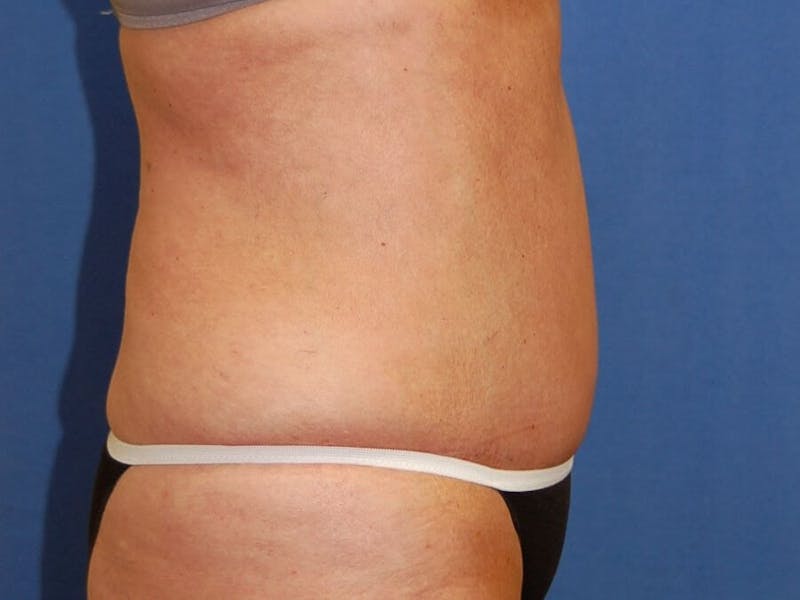 Tummy Tuck Before & After Gallery - Patient 89987854 - Image 6