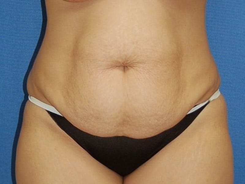 Tummy Tuck Before & After Gallery - Patient 89987855 - Image 1