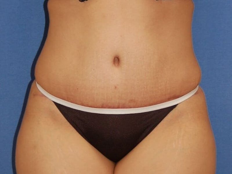 Tummy Tuck Before & After Gallery - Patient 89987855 - Image 2