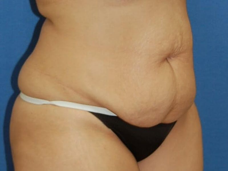 Tummy Tuck Before & After Gallery - Patient 89987855 - Image 3