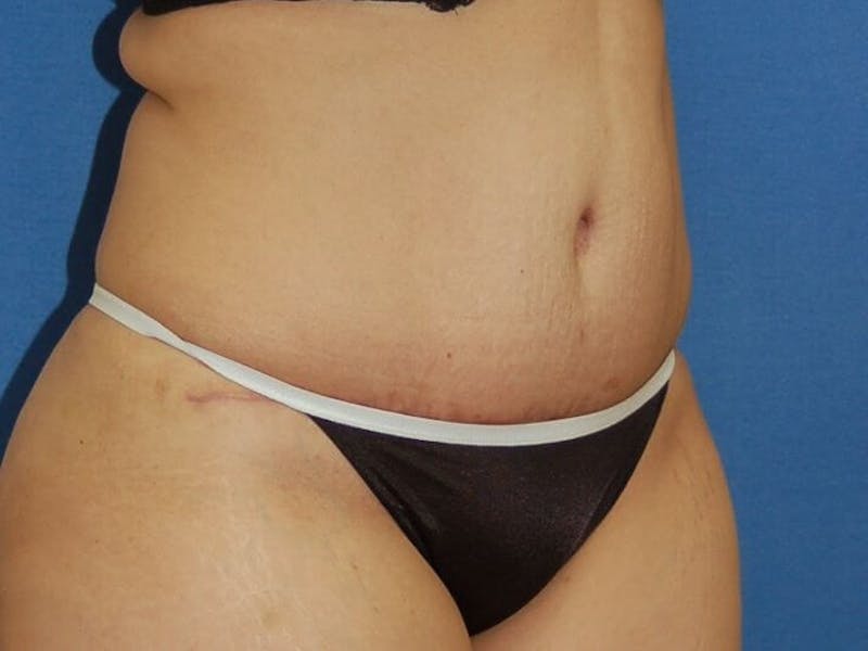 Tummy Tuck Before & After Gallery - Patient 89987855 - Image 4