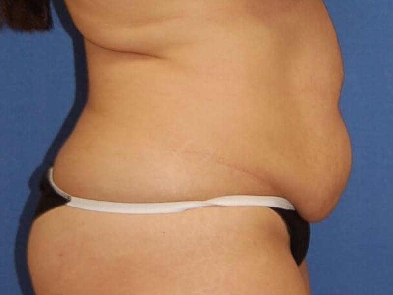 Tummy Tuck Before & After Gallery - Patient 89987855 - Image 5
