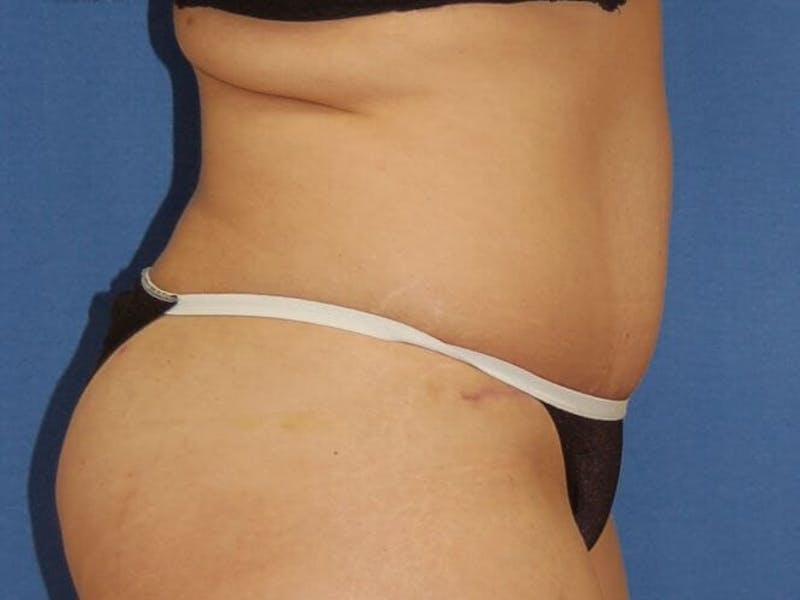 Tummy Tuck Before & After Gallery - Patient 89987855 - Image 6