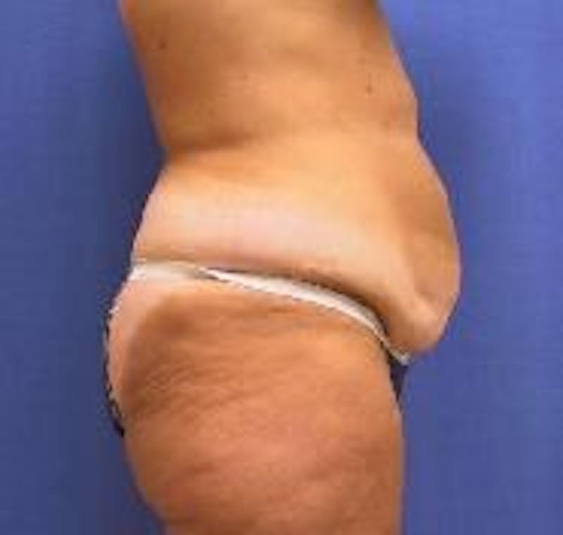 Tummy Tuck Before & After Gallery - Patient 89987856 - Image 1