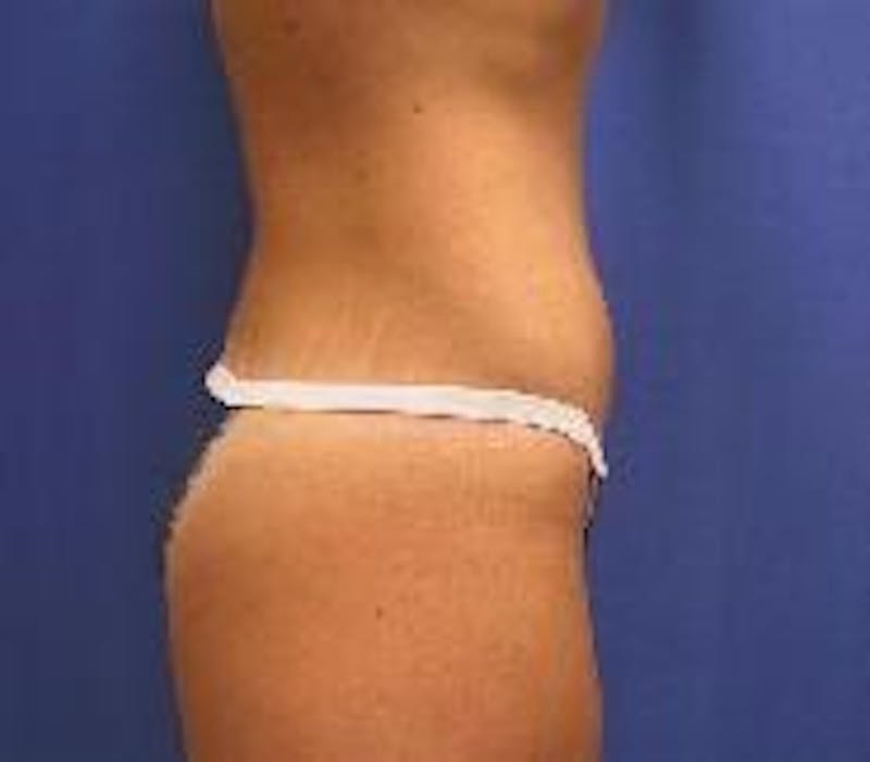 Tummy Tuck Before & After Gallery - Patient 89987856 - Image 2