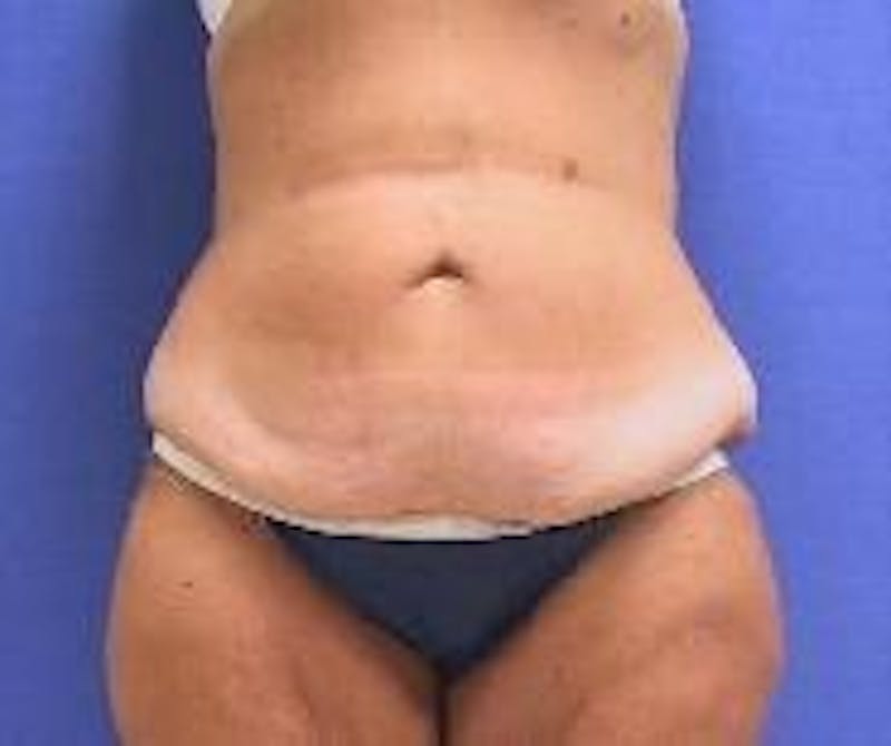 Tummy Tuck Before & After Gallery - Patient 89987856 - Image 3
