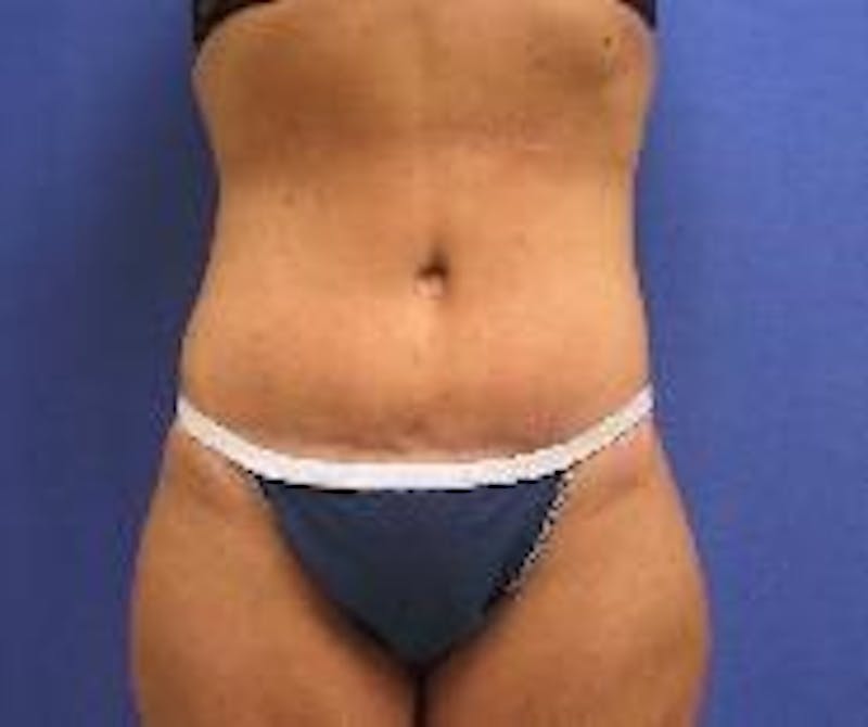 Tummy Tuck Before & After Gallery - Patient 89987856 - Image 4